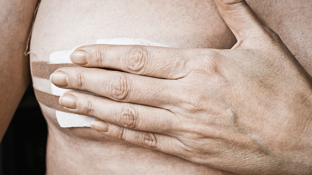Radioaktivt spårämne kan ersätta biopsi vid aggressiv bröstcancer