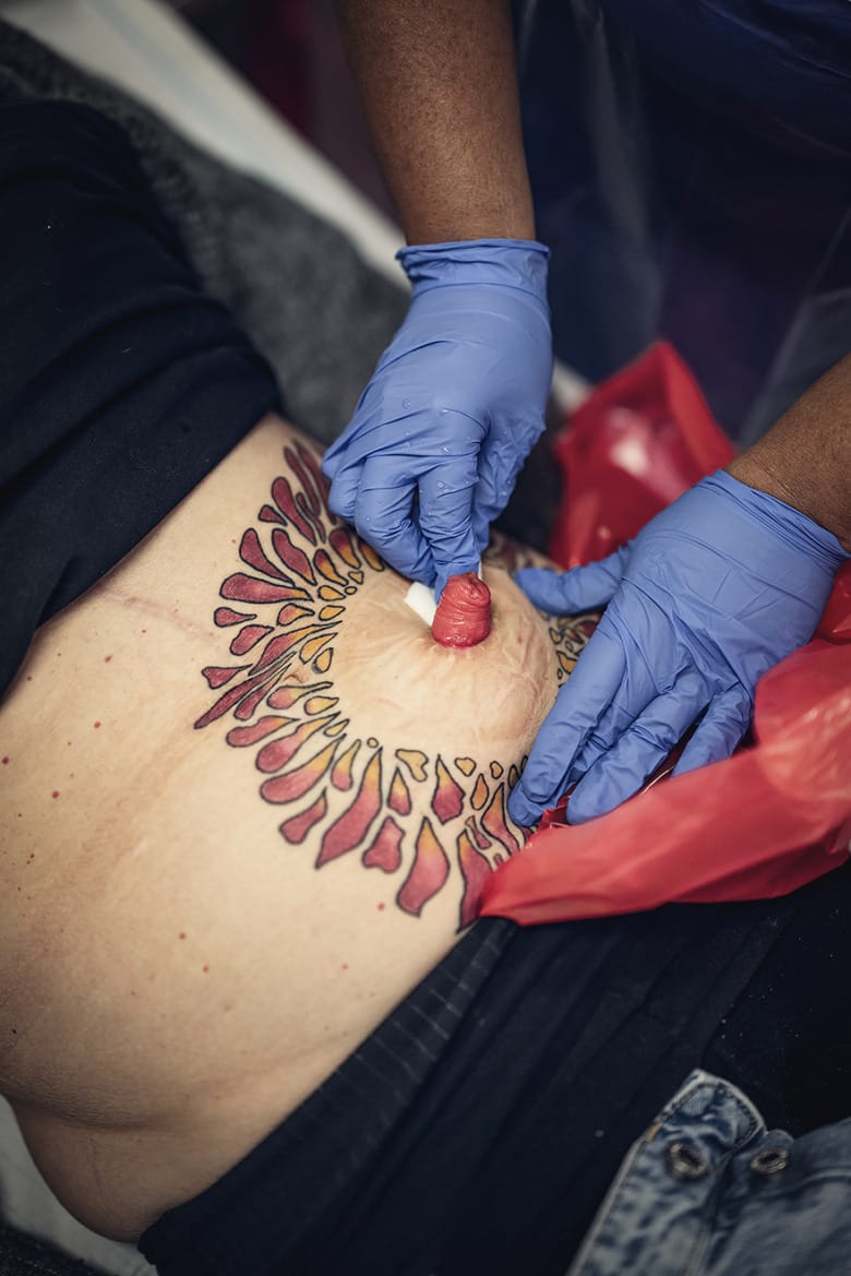 Två händer iklädda blå plasthandskar syns mot en bar, men tatuerad mage med stomi.
