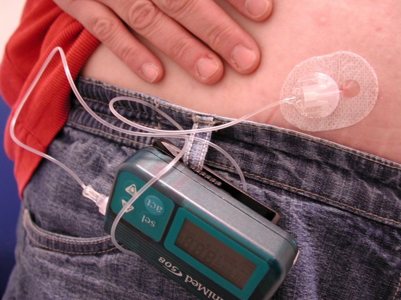 Tidig diabetes förkortade kvinnors liv med 18 år
