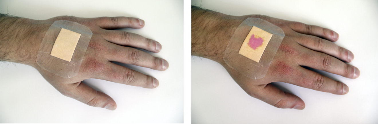 Nytt plåster visar läkningsprocessen | Vårdfokus