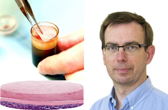 Plåster med blod läker svåra sår vid diabetes