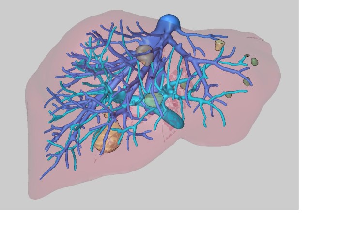 Fler svåra fall av levercancer kan botas med ny teknik