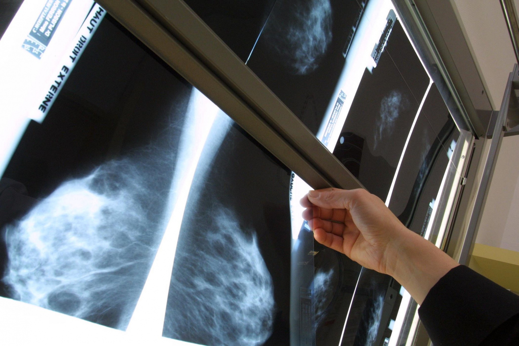 Implantat kan försvåra tolkning av mammografi